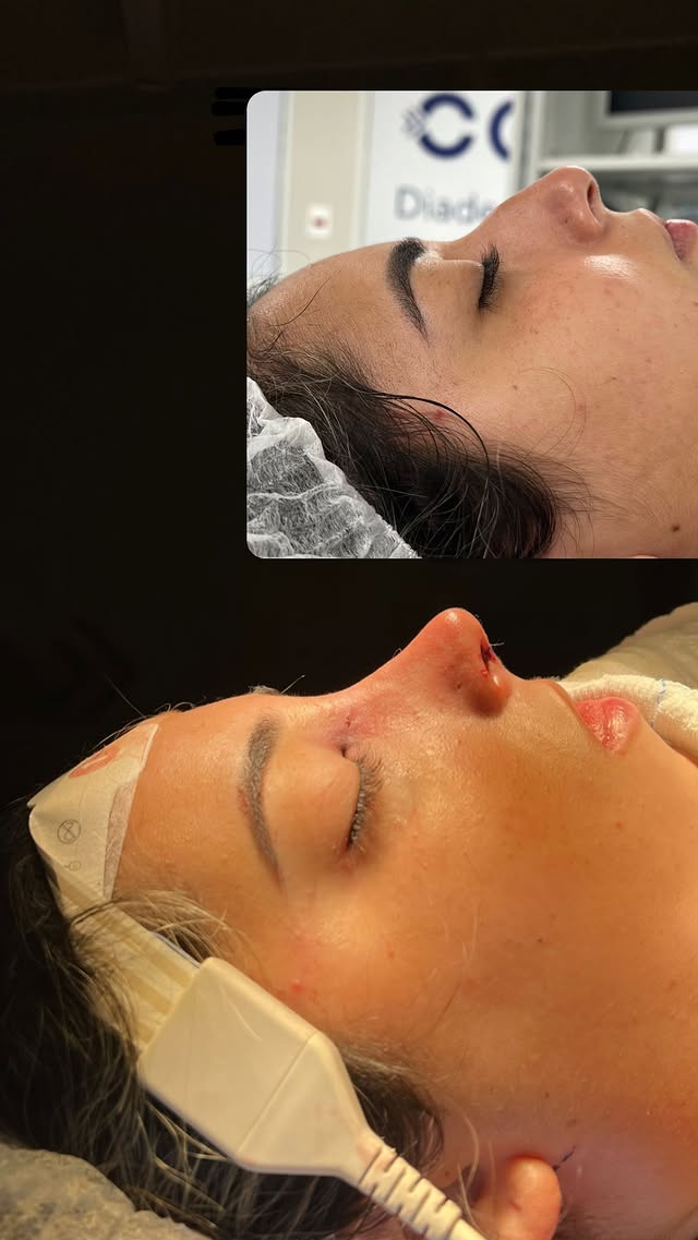 Resultado de paciente após rinoplastia