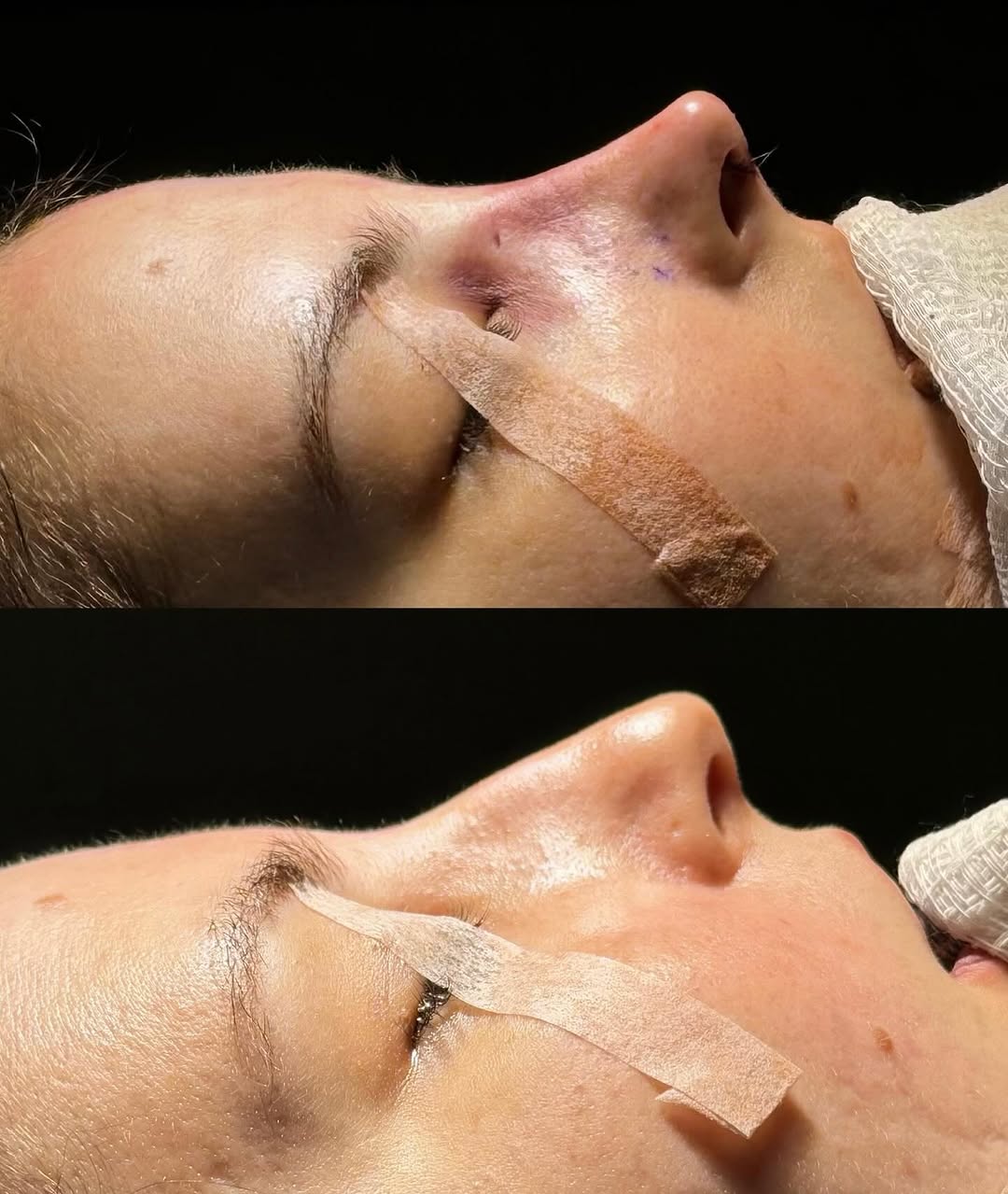 Resultado de paciente após tratamento de obstrução nasal